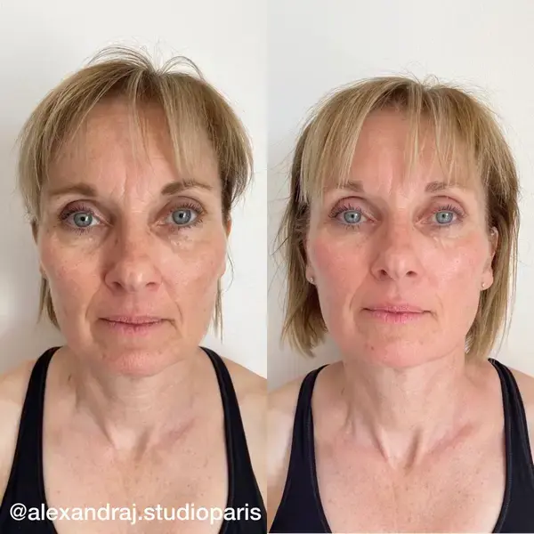 Before and after, Sculptural Face Lifting